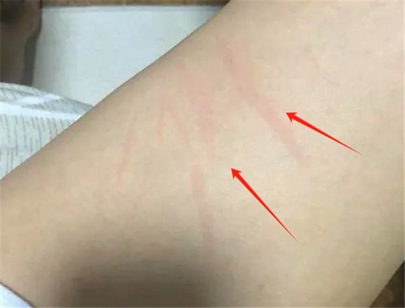 被小狗爪子抓了一条红痕要紧吗